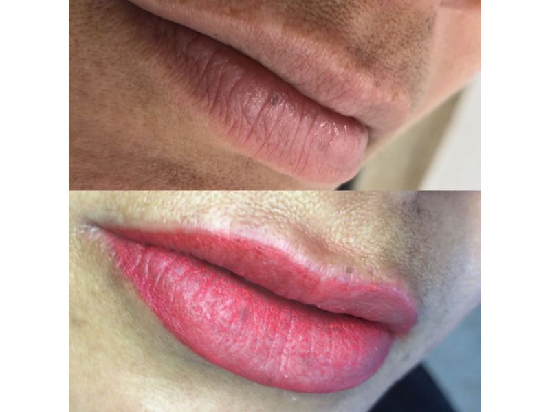 Revitalização Labial
